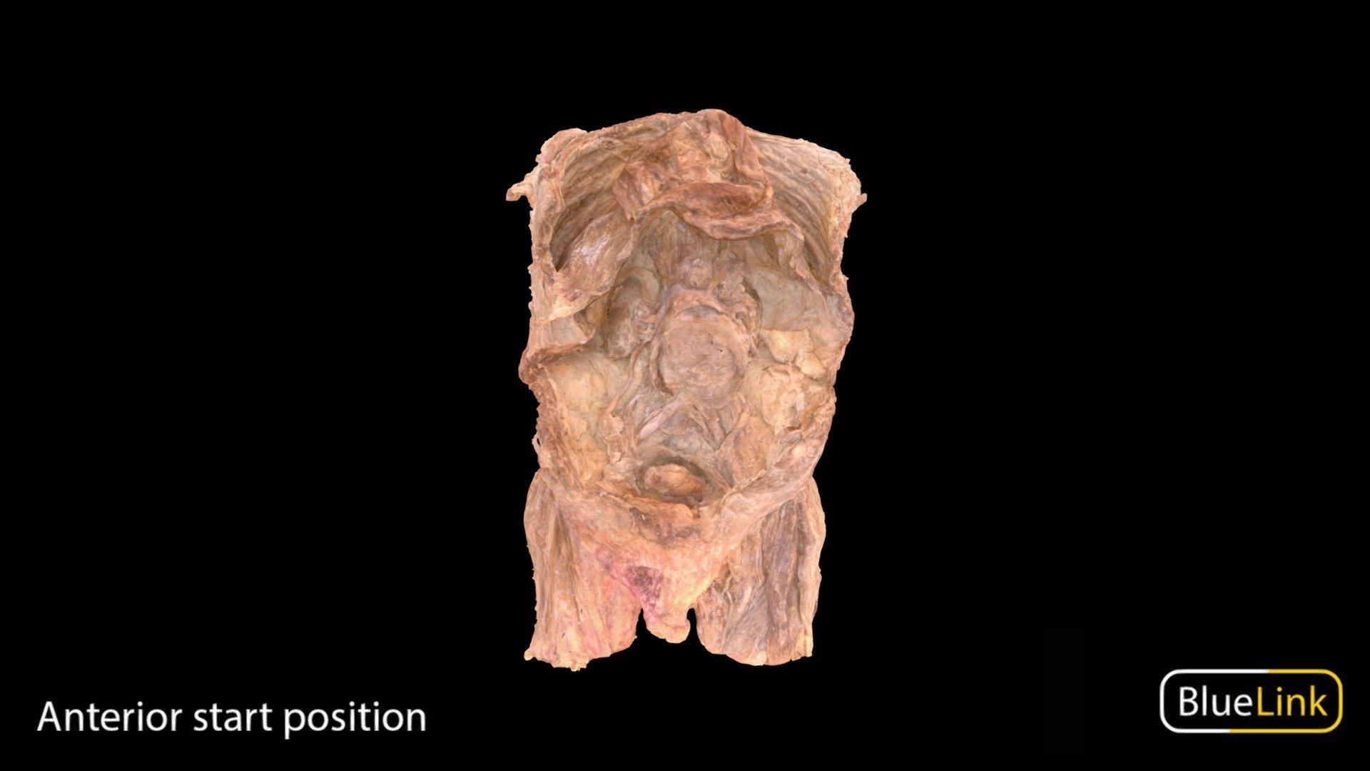 3D scan of an abdominal aortic aneurysm in a human abdomen specimen
Captured with: Einscan Pro
Captured by: Will Gribbin
Edited by: Cristina Prall
University of Michigan 
91052-T01 - Abdominal Aortic Aneurysm - 3D model by Bluelink Anatomy - University of Michigan (@bluelinkanatomy) 3d model