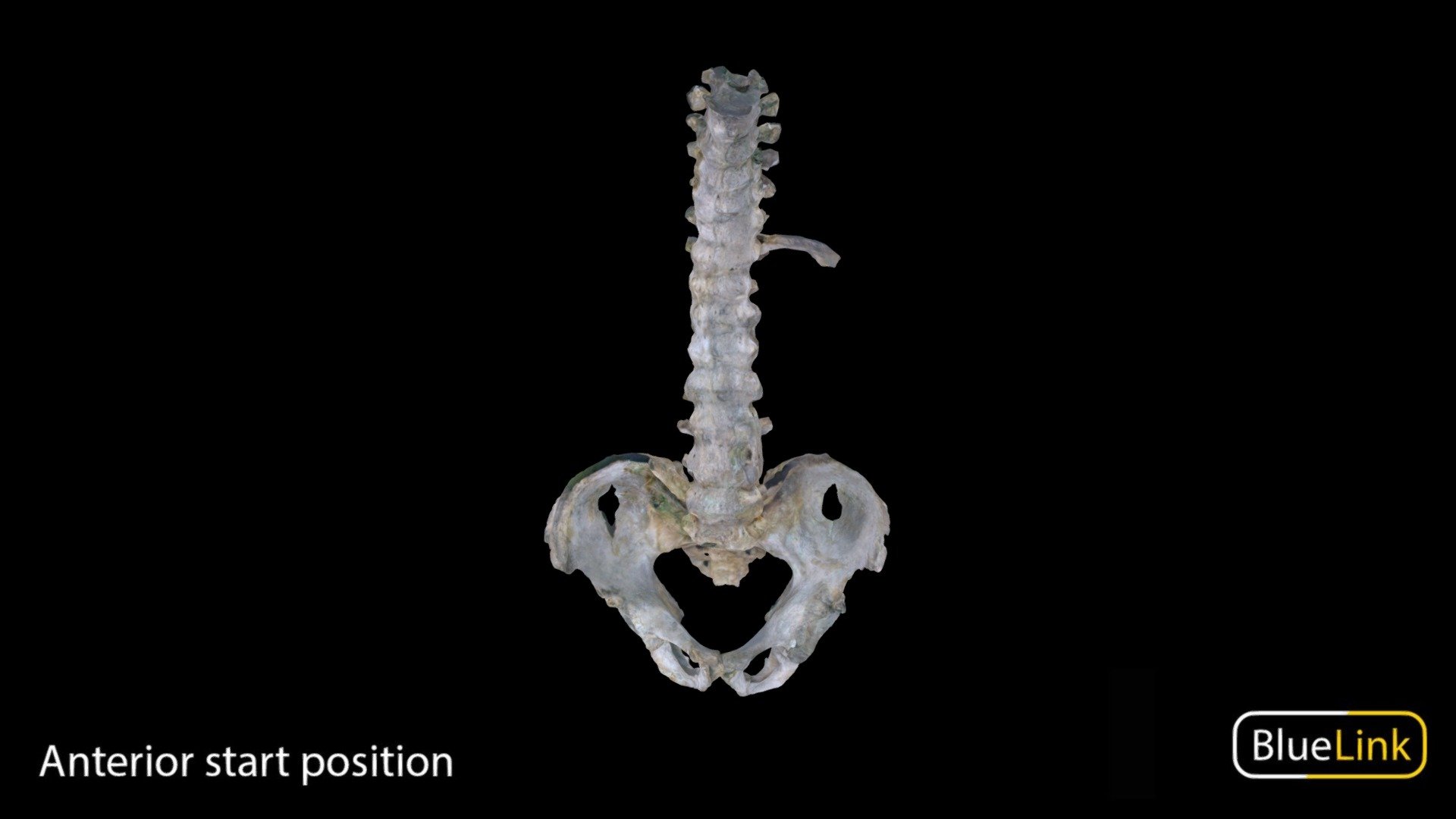 Human spinal column with ankylosing spondylitis
Captured with: EinScan Pro
Captured by: Will Gribbin
Edited by: Cristina Prall
University of Michigan - Ankylosing Spondylitis - 3D model by Bluelink Anatomy - University of Michigan (@bluelinkanatomy) 3d model