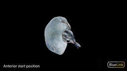 Bisected Right Kidney anatomy, medicine, kidney, michigan, university-of-michigan, renal, bluelink