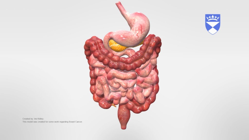 A 3d model sculpted by the MSc Medical Art student Imi Ridley. This work has been used as part of a poster for Ninewells Hospital Dunnde for explaining the staging of bowel cancer.