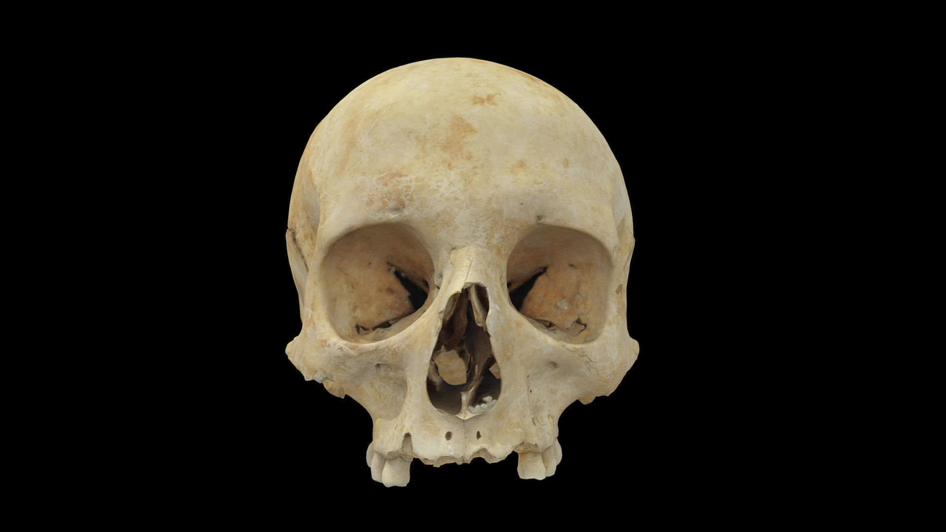 This skull was found in 2017 in Royston - North Hertfordshire. It was found in a private garden, due to the owners having a small extension built. 
There were 9 individuals found in the same area. This skull is that of a woman in her early 20's. 
Next to the site in the 1830's another burial was discovered, this time with spears and their heads to the west. This is why we have reason to believe that this skull is from the 7th Century Saxons period. 

The remains found have now been re-buried in the same site 3d model