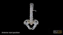 Ankylosing Spondylitis anatomy, human