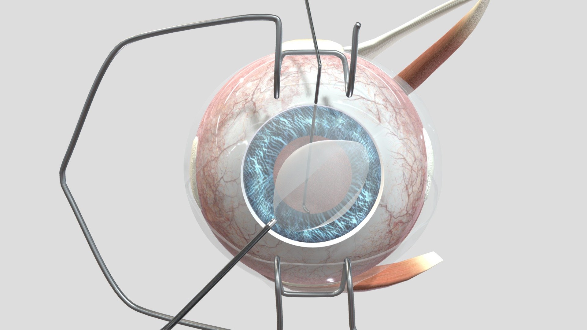 Descemet Membrane Endothelial Keratoplasty. Removal of descemet membrane 3d model